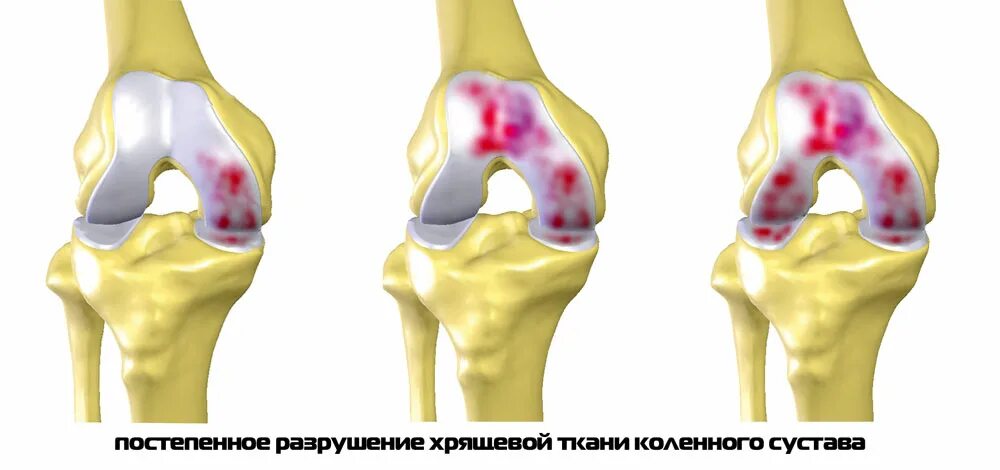 Артропатия коленных суставов. Повреждение коленного хряща. Разрыв суставного хряща коленного сустава. Гонартроз коленного сустава.