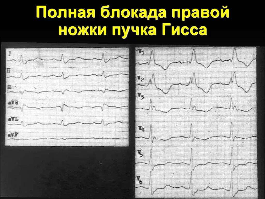 Блокада правой ножки желудочка. Блокада ПНПГ на ЭКГ. ЭКГ полная блокада правой ножки пучка. ЭКГ полная блокада правой ножки п.Гиса. Блокада правой ножки пучка Гиса.