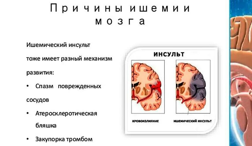 Шансы выжить после инсульта. Последствия ишемического инсульта головного. Ишемический инсульт головного мозга последствия.