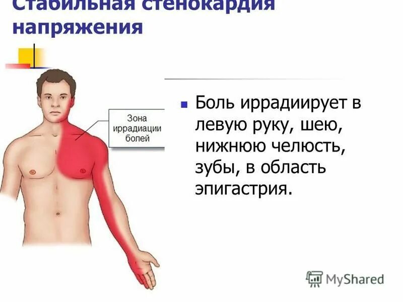 Сильная загрудинная боль. Зоны иррадиации боли при стенокардии. Иррадиация боли в сердце. Локализация боли в груди. Локализация боли при ИБС.