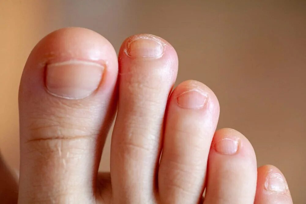 Ногти на больших пальцев мужчин. Здоровые ногти на ногах. Ногти на ногах здорового человека. Грибок на ногтей ногах мищинца.