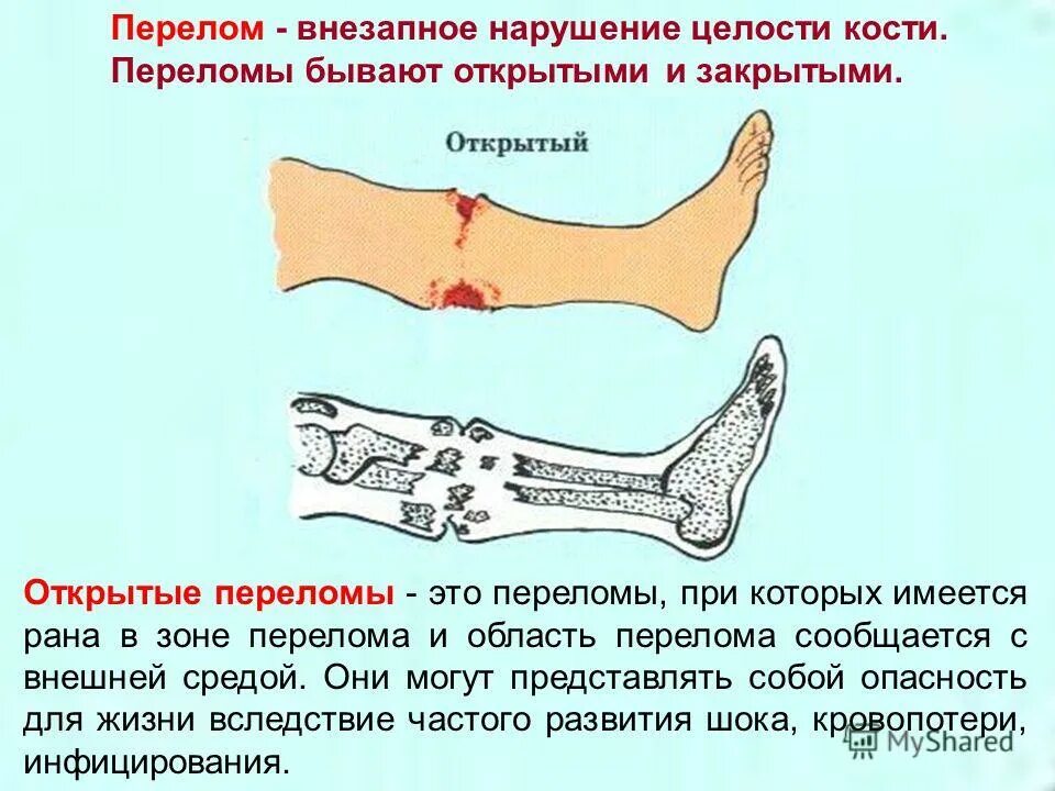 Степени открытого перелома. Презентация на тему открытый перелом. Открытый перелом кости. Открытые и закрытые переломы.