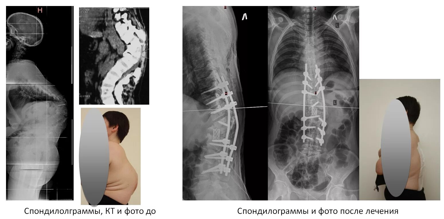 Оперативное лечение позвоночника. Сколиоз 1 степени поясничного отдела рентген. Сколиоз позвоночника 3 степени рентген. Операция на сколиоз 3 степени. Кифоз сколиоз операция.