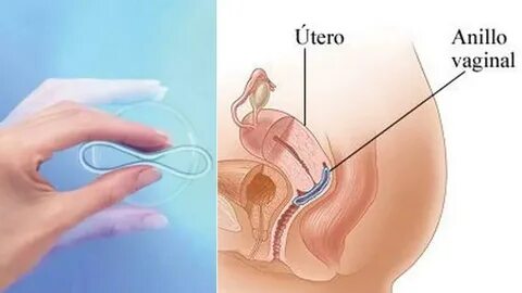 como se usa el anillo hormonal.