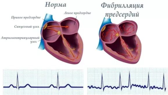 Мерцательная аритмия после операции