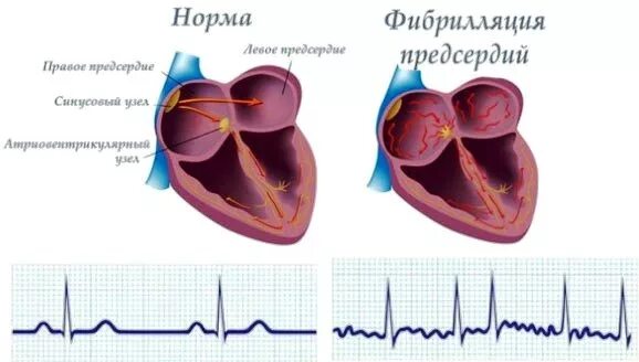 Фибрилляция предсердий операция прижигание. Абляция при фибрилляции предсердий. РЧА при мерцательной аритмии. Показания к РЧА при фибрилляции предсердий. Норма правого предсердия