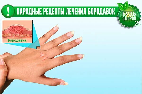 Народные методы избавления от бородавок. Лечим бородавки народными средствами. Народные методы избавления от папиллом. Народные средства при бородавке. Как убрать бородавку народными средствами.