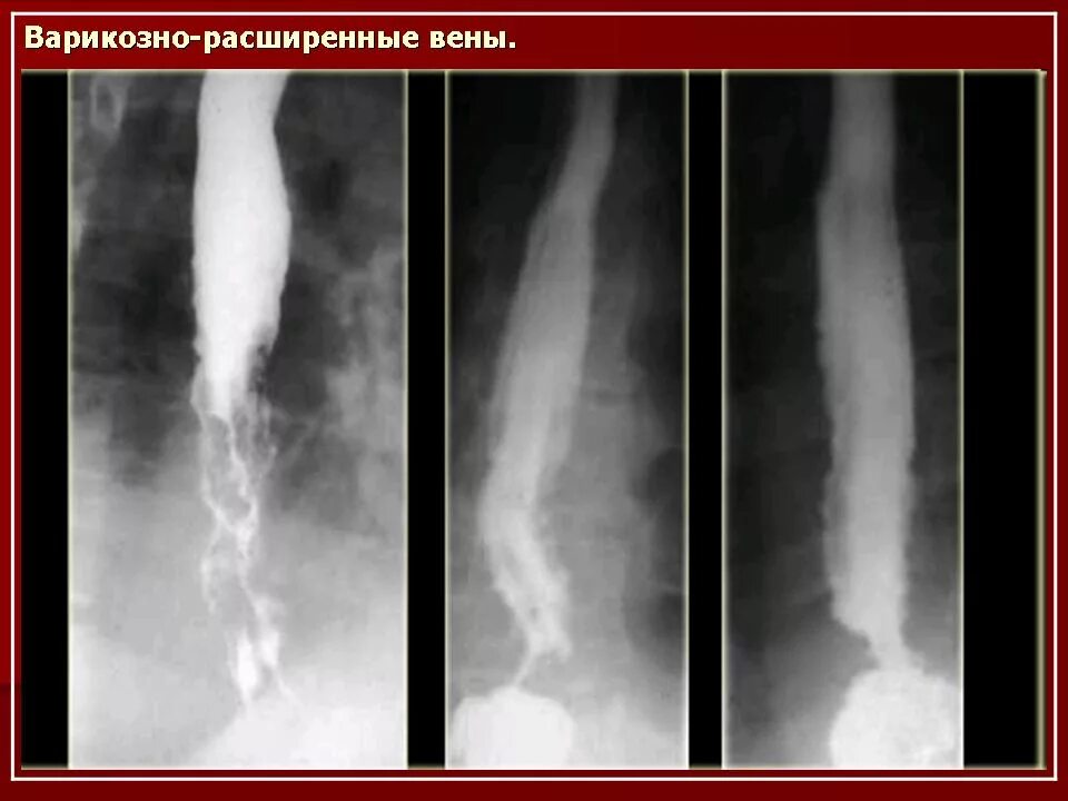 Пищевода с барием. Контрастирование пищевода рентген. Стриктура пищевода рентген симптомы. Пищевод Барретта рентгеноскопия. Патология пищевода рентген.