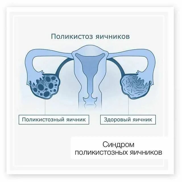 Спкя питание. Питание яичников у женщин. Питание яичников у женщин. Поликистоз яичников гормоны. Питание яичников у женщин.