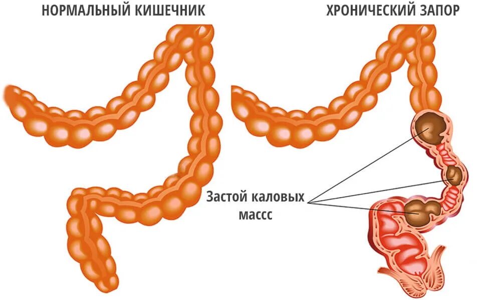 Запор. Хронический запор. Почему появляется запор