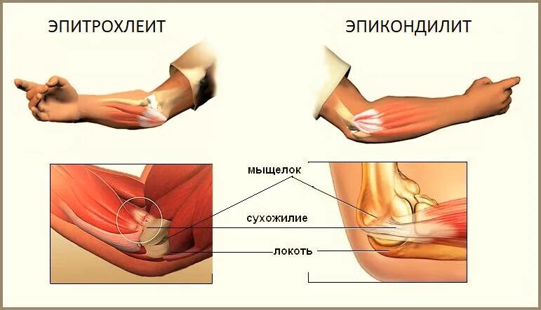 Лечение медиального эпикондилита локтевого