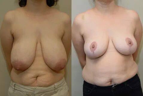 Breast Reduction For Women