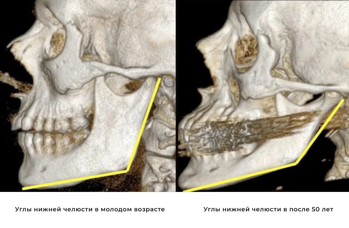 Деформация кости черепа. Резорбция костей челюсти. Резорбция костей лицевого черепа. Резорбция костной ткани верхней челюсти.