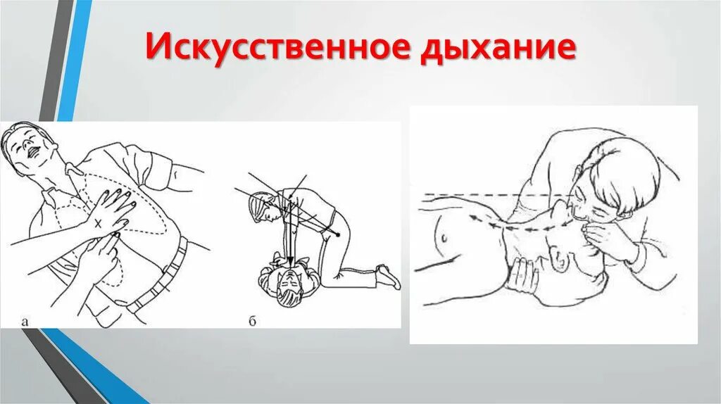 Схема искусственного дыхания. Схему выполнения искусственного дыхания.. Искусственное дыхание урок. Приемы искусственного дыхания