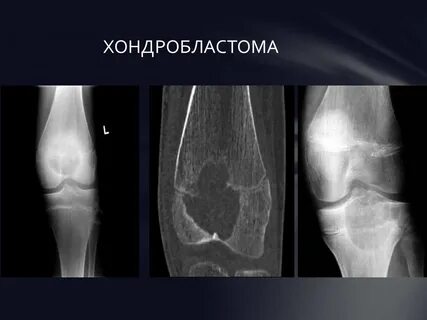 Злокачественные опухоли костей