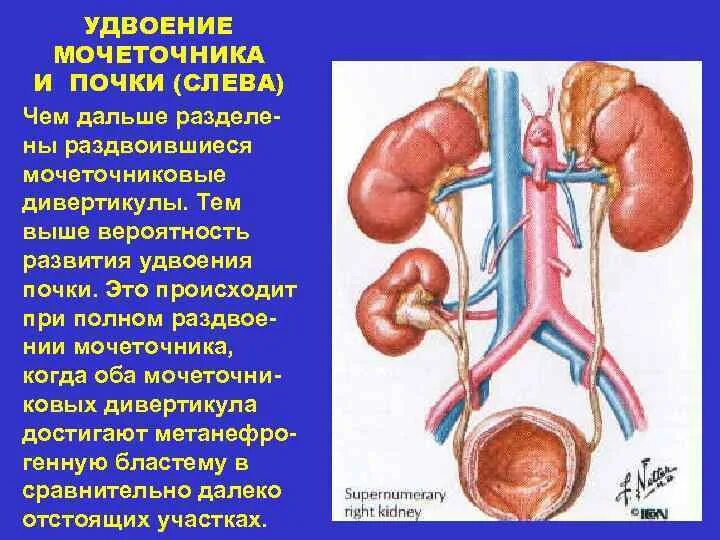 Два мочеточника. Удвоение ЧЛС почки. 2 Мочеточника у почки. Удвоение почек и мочеточников это.