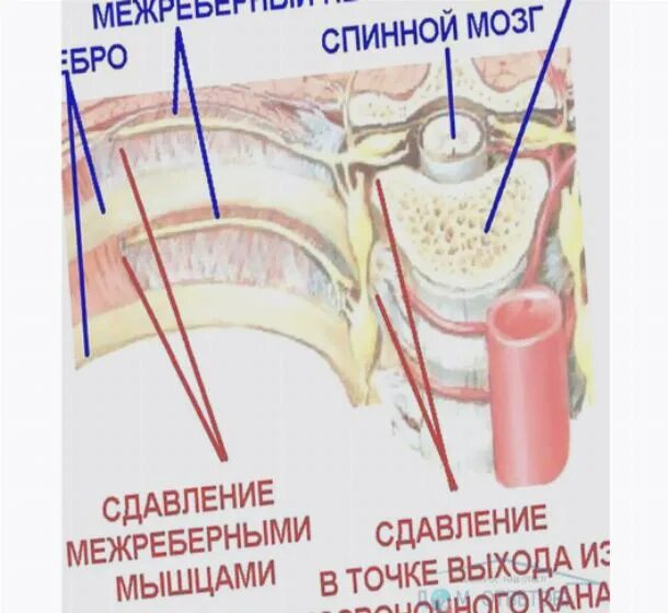 Межреберная невралоги. При межреберной невралгии. Межреберная невралгия болевые точки. Межрёберная невралгия слева. Межреберная невралгия лечение в домашних условиях слева