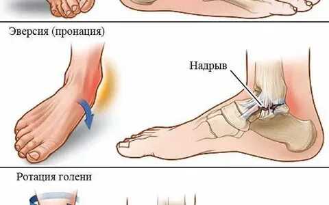 Растяжение связок голеностопного сустава лечение мазь