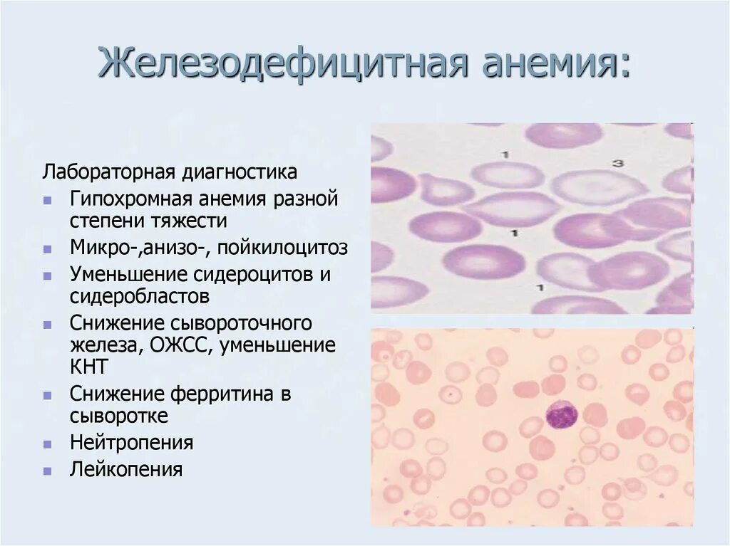 Лейкопения при анемии. Жда анемия гипохромная. Железодефицитная анемия пойкилоцитоз. . Анизо-пойкилоцитоз; жда. Пойкилоцитоз при жда.