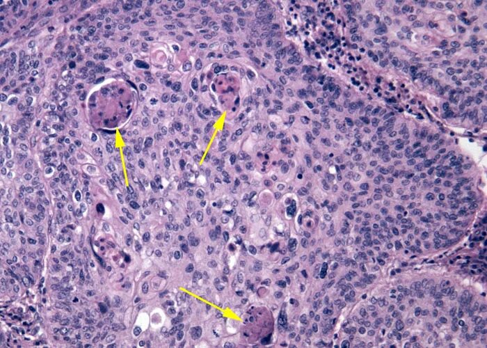 Клеточный атипизм гистология. Тканевый атипизм патанатомия. Тканевой атипизм опухолей. Атипизм опухоли патанатомия. Плоскоклеточный неороговевающий рак шейки
