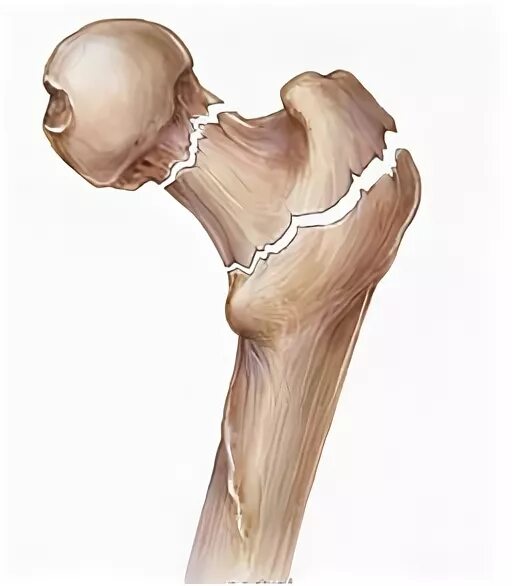 самая хрупкая кость. самая хрупкая кость. самая хрупкая кость. самая твёрдая кость в теле человека. кости ноги человека сбоку.