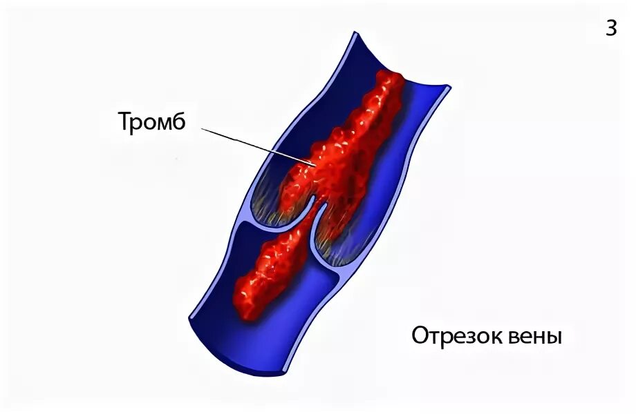 Тромбоз у детей