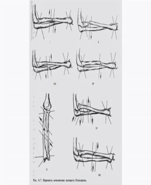 перелом локтевого отрос. можно ли сломать локоть. перелом локтевого отростка локтевой кости. перелом отростка локтевого сустава. краевой перелом венечного отростка локтевой.