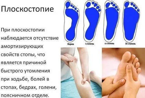 Плоскостопие массаж видео