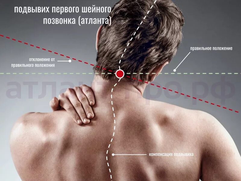 Шейный подвывих у взрослых. Смещенные шейные позвонки. шейный позвонок атлант. смещение шейного позвонка атланта. подвывих атланта шейного отдела позвоночника.