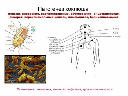Коклюш вирус или бактерия