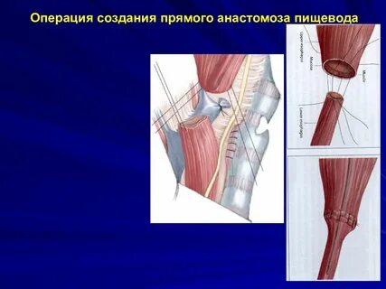 Хирургия пищевода