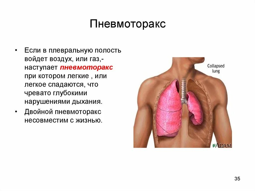 Попадание воздуха в полость. Пристеночный пневмоторакс. Легкие и плевральная полость.