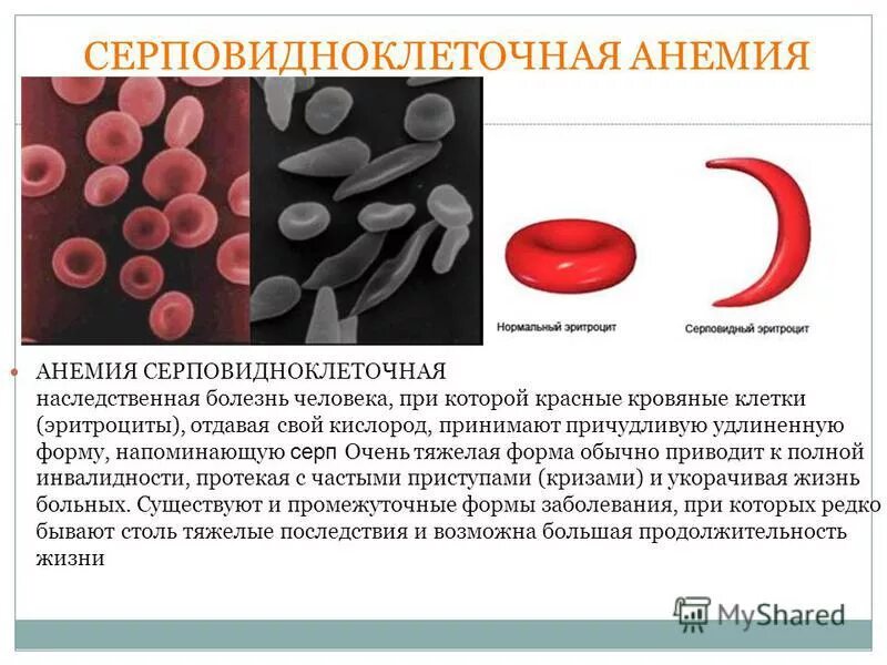 Ген серповидноклеточной анемии. Причина заболевания серповидноклеточной анемии. Серповидноклеточная анемия генное заболевание. Серповидно-клеточная анеми. Серповидная анемия эритроциты.