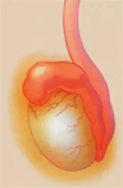 Трихомонадный эпидидимит. Эпидидимит, орхит, орхоэпидидимит. Гонококковый эпидидимит. Гонорейный эпидидимит. Болит в правом яичке у мужчин