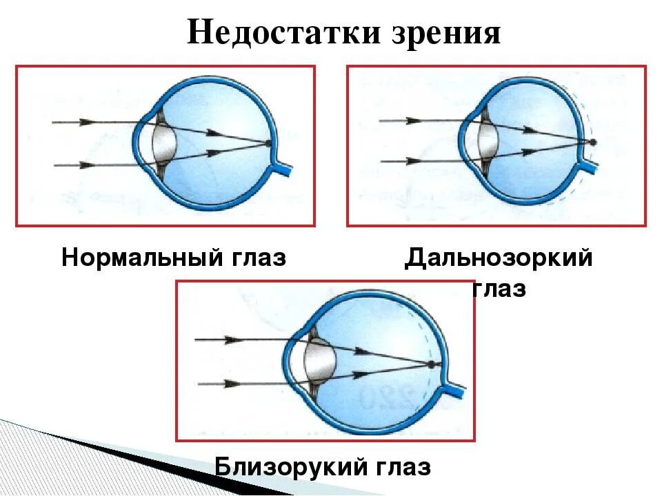 По распространенной точке зрения чтение. Дефекты зрения. Дефекты зрения физика. Линзы и дефекты зрения. Строение глаза дефекты зрения.