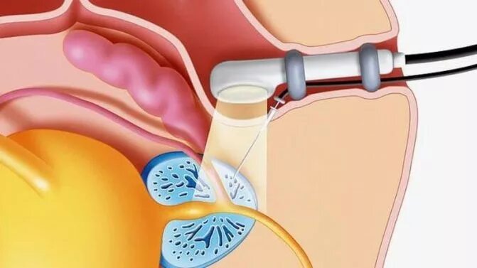 Трансректальное УЗИ простаты. УЗИ трузи предстательной железы. Трузи (трансректальное ультразвуковое исследование). Ультразвуковое исследование предстательной железы трансректальное.