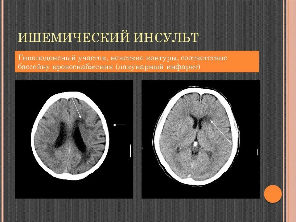 Левая средняя мозговая артерия инсульт. Ишемический инсульт в ВББ на кт. Инфаркт мозга на кт. Атеротромботический ишемический инсульт кт. Вертебробазилярный бассейн головного мозга ишемический инсульт.