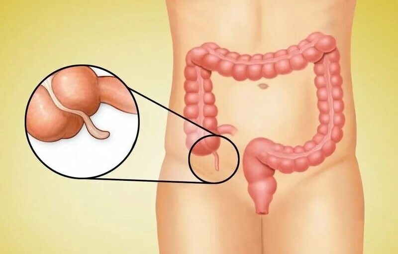 The appendix is a tiny little organ that has no apparent function, but causes se
