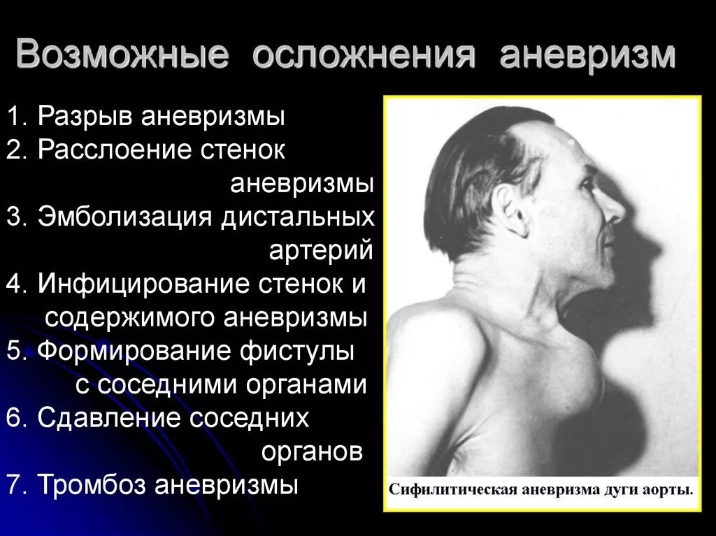 Осложнения аневризмы аорты. Причины возникновения аневризмы. Разрыв аневризмы симптомы. Разрыв артериальной аневризмы.