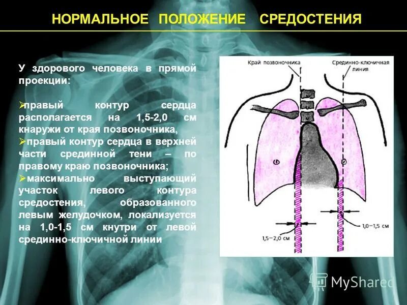 Матка retroflexio retroversio. Нормальное положение органа. Условные линии, определяющие положение органов в теле. Ударение волосковые клетки. Нормальное положение органа.