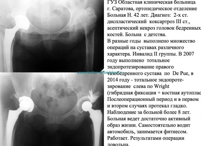 Коксартроз тазобедренного 3 степени операция. Коксартроз тазобедренного 3 степени операция