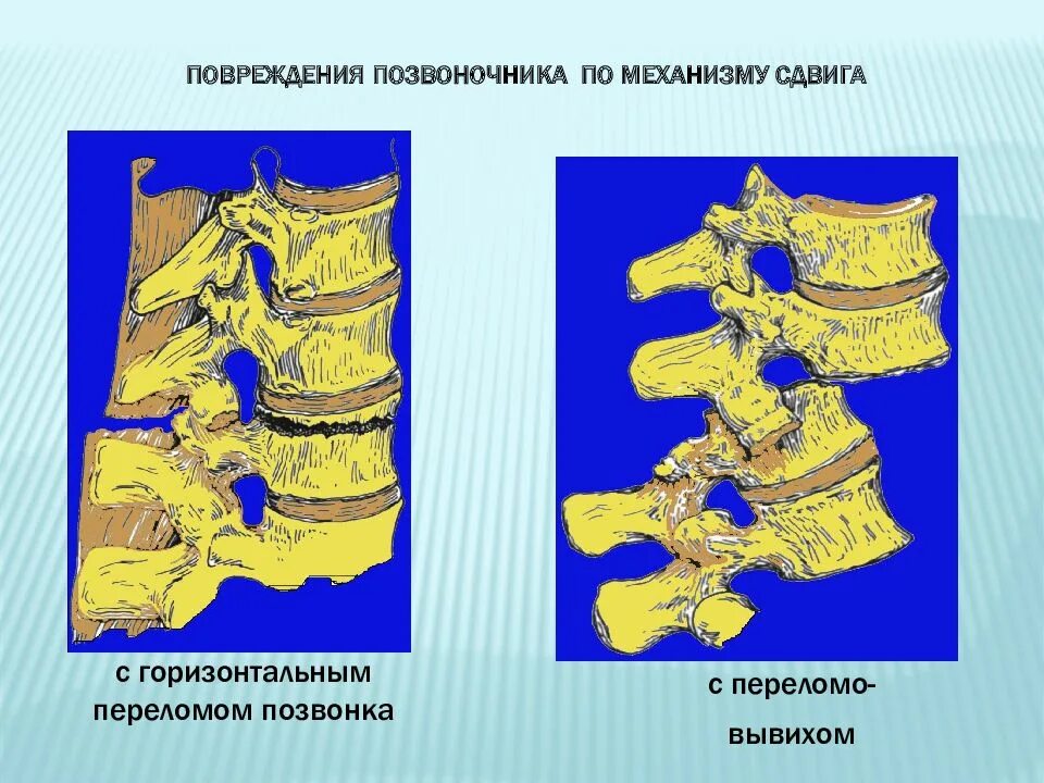 Повреждения позвоночника переломы. Механизмы повреждения позвоночника. Механизмы травмы позвоночника. Повреждения позвоночника по механизму сдвига. Повреждение позвоночника механизм повреждения.