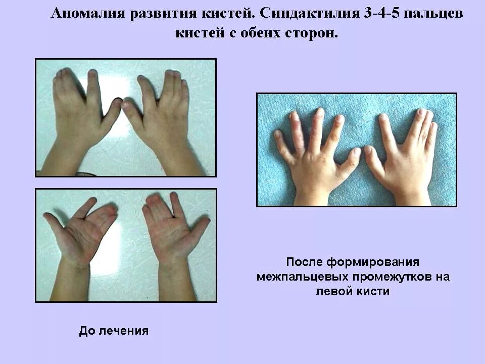 Имеет два развитых пальца. Врожденные деформации синдактилия. Синдактилия Тип наследования. Пороки развития кисти синдактилия.