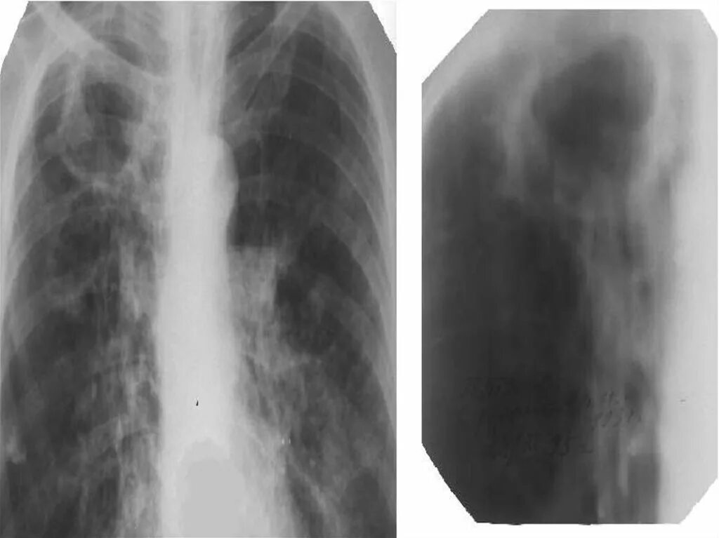 Туберкулез легкого рентгенограмма. Фиброзно-кавернозный туберкулез рентген. Кавернозный туберкулёз лёгких рентген. Фиброзно-кавернозный туберкулез легких рентген. Кавернозный туберкулез легких рентген.