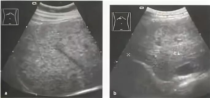 Увеличенная печень на узи. Хвостатая и квадратная доли печени на УЗИ. Обогащение сосудистого рисунка печени. Гиперплазия хвостатой доли печени на УЗИ. Неоднородная структура печени на УЗИ.