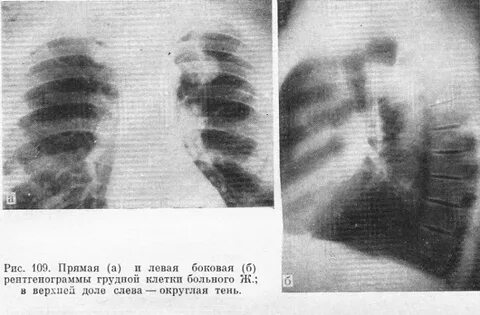 Очаг в верхней доле левого легкого