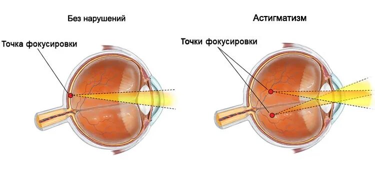 С точки зрения наличия в. Строение глаза человека астигматизм. Болезни глаз дальнозоркость близорукость. Миопия гиперметропия астигматизм. Заболевание органов зрения миопия.