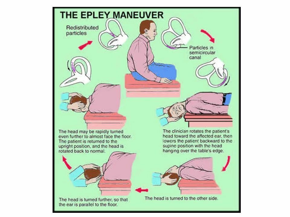 Маневры эплей. Epley maneuver. Метод Эппле при головокружении. Позиционное головокружение упражнения. ДППГ маневр Эпли.