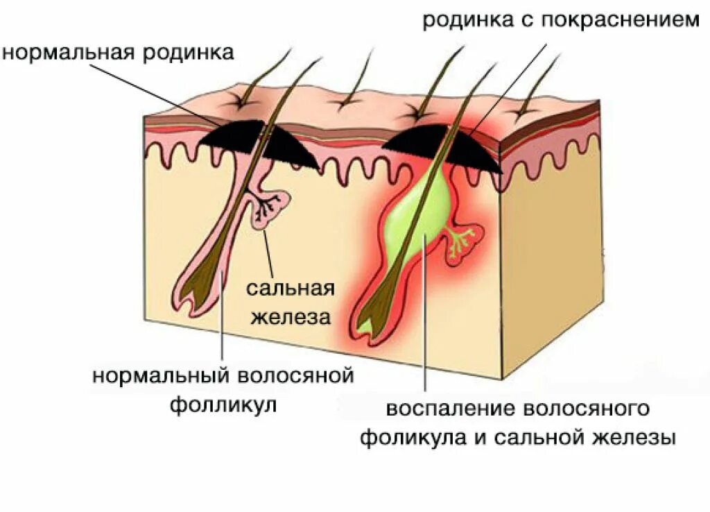 Фолликулит волосяного фолликула. Волосяной фолликул и сальная железа. Воспаление волосяного фолликула. Воспаление сально волосяного фолликула. Почему колду