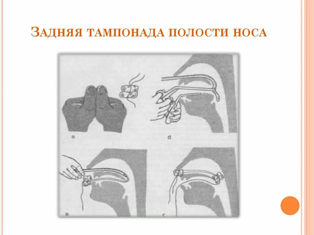 Тампонада носа при носовом кровотечении. Передняя и задняя тампонада носа алгоритм. Набор для задней тампонады носа. Задняя тампонада носовой полости. Набор для передней тампонады носа.